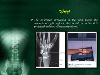 The 20-degree angulation of the wrist places the
scaphoid at right angles to the central ray so that it is
projected without self-superimposition.
Wrist
 