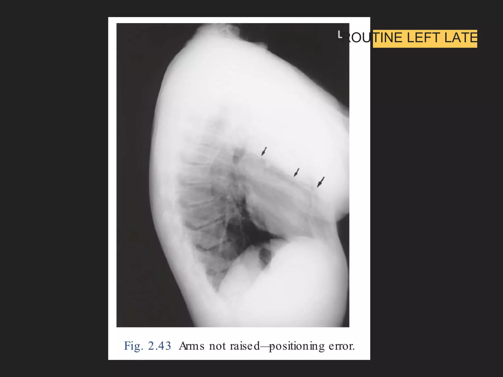 ROUTINE LEFT LATERAL