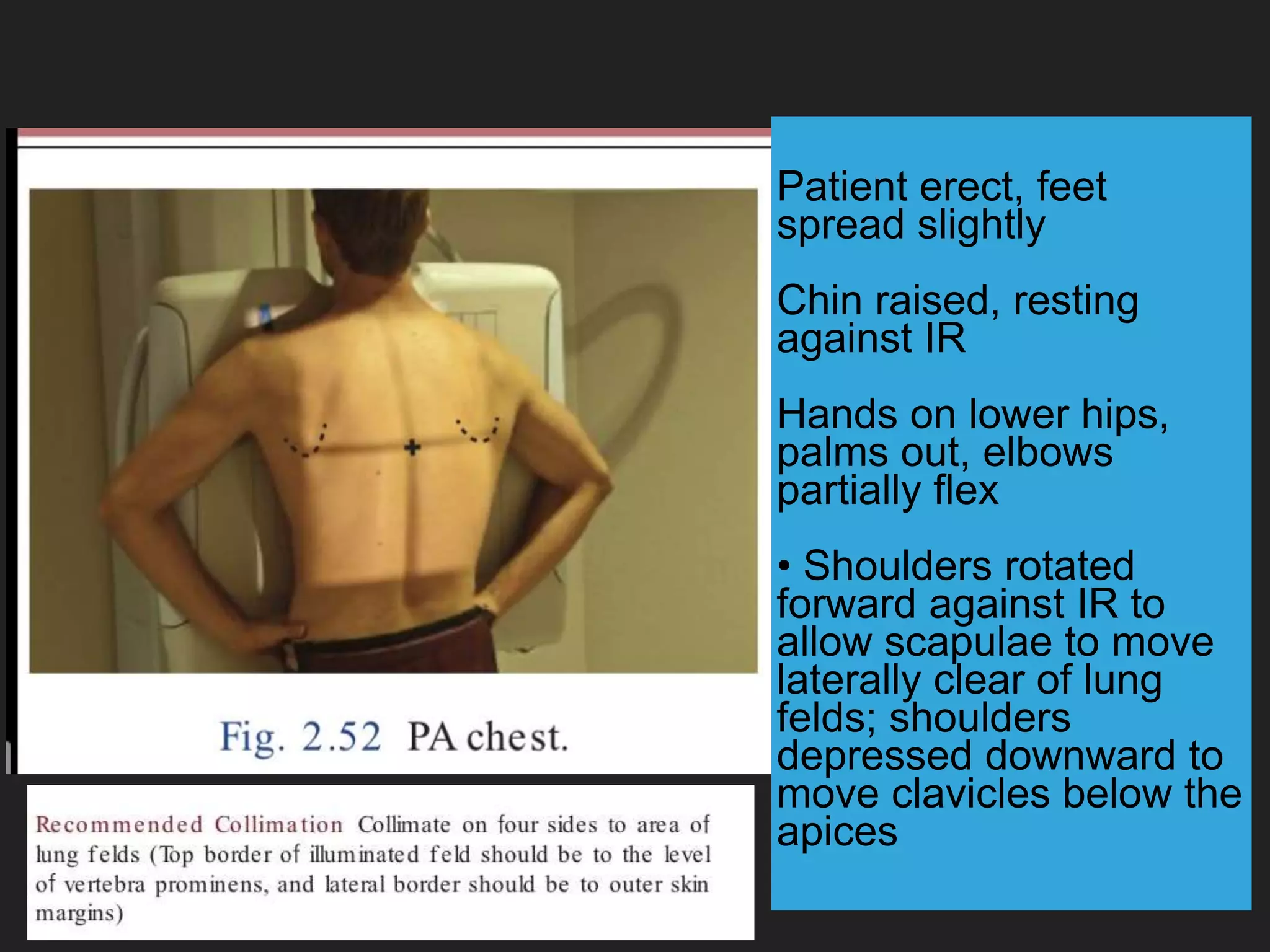 Patient erect, feet
spread slightly
Chin raised, resting
against IR
Hands on lower hips,
palms out, elbows
partially flex
• Shoulders rotated
forward against IR to
allow scapulae to move
laterally clear of lung
felds; shoulders
depressed downward to
move clavicles below the
apices