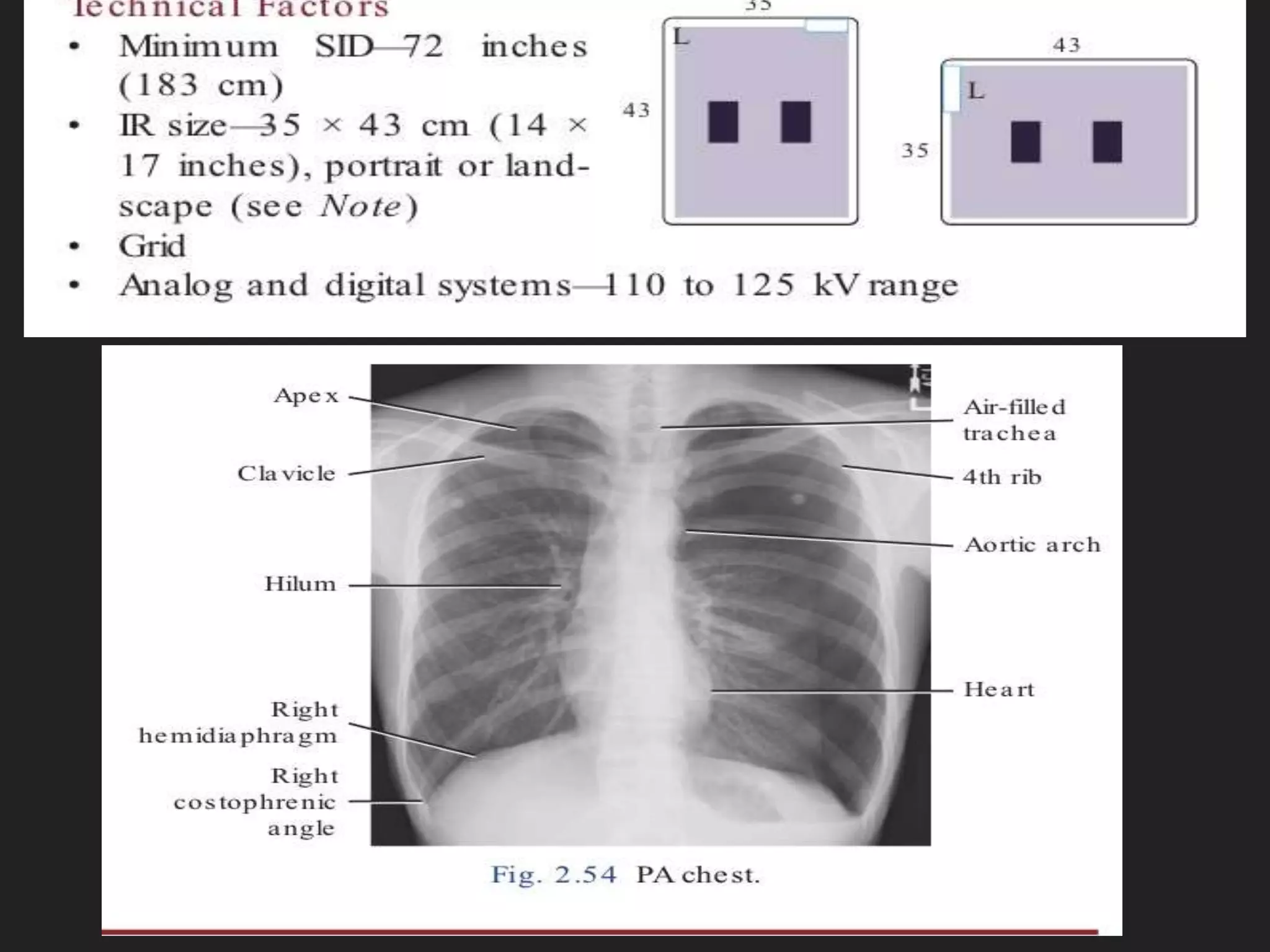 Technique cxr