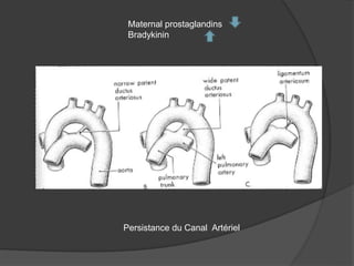 Persistance du Canal Artériel
Maternal prostaglandins
Bradykinin
 