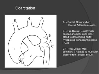 A) - Ductal: Occurs when
Ductus Arteriosus closes
B) - Pre-Ductal: Usually with
cardiac anomaly since less
blood to descending aorta:
hypoplastic aorta (cannot close
PDA)
C) - Post-Ductal: Most
common; ? Related to muscular
closure from “ductal” tissue
Coarctation
 