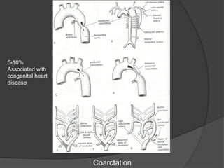 Coarctation
5-10%
Associated with
congenital heart
disease
 