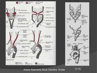 Artere Aberrante Sous Clavière Droite 0.1%
 