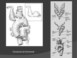 Diverticule de Kommerell
 