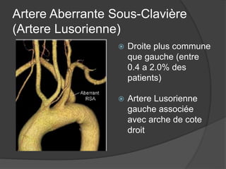 Artere Aberrante Sous-Clavière
(Artere Lusorienne)
 Droite plus commune
que gauche (entre
0.4 a 2.0% des
patients)
 Artere Lusorienne
gauche associée
avec arche de cote
droit
 