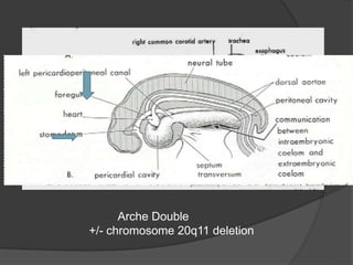 Arche Double
+/- chromosome 20q11 deletion
 
