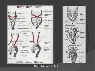 Right Sided Aortic Arch
 