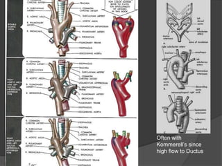 Often with
Kommerell’s since
high flow to Ductus
 