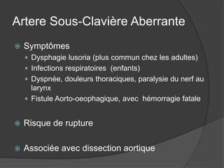 Artere Sous-Clavière Aberrante
 Symptômes
 Dysphagie lusoria (plus commun chez les adultes)
 Infections respiratoires (enfants)
 Dyspnée, douleurs thoraciques, paralysie du nerf au
larynx
 Fistule Aorto-oeophagique, avec hémorragie fatale
 Risque de rupture
 Associée avec dissection aortique
 
