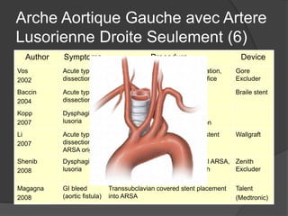 Arche Aortique Gauche avec Artere
Lusorienne Droite Seulement (6)
Author Symptoms Procedure Device
Vos
2002
Acute type B
dissection
R car-subc transposition, ARSA ligation,
transfemoral occlusion of ARSA orifice
Gore
Excluder
Baccin
2004
Acute type B
dissection
TEVAR Braile stent
Kopp
2007
Dysphagia
lusoria
R car-subc bypass,
Transbrachial ARSA origin occlusion
Li
2007
Acute type B
dissection at
ARSA origin
Transfemoral insertion of covered stent
into ARSA
Wallgraft
Shenib
2008
Dysphagia
lusoria
R car-subc bypass, ligation of distal ARSA,
anterograde occlusion of ARSA with
excluder
Zenith
Excluder
Magagna
2008
GI bleed
(aortic fistula)
Transsubclavian covered stent placement
into ARSA
Talent
(Medtronic)
 