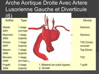 Arche Aortique Droite Avec Artere
Lusorienne Gauche et Diverticule
(6)
Author Type of OR Procedure Device
Okada
2001
1 stage
(no hybrid)
TEVAR Gianturo
Myamoto
2002
1 stage
(hybrid)
Open supra-aortic repair, intra-
aortic stent insertion on CPB
Gianturo
Chiesa
2007
1 stage
(hybrid)
Open triple graft (sternotomy),
ARSA occlusion, TEVAR
TX2 (Cook),
occluder
Naoum
2008
1 stage
(hybrid)
L car-subcl bypass,
ligation of ARSA, TEVAR
Tag (Gore)
Klonaris
2009
1 stage
(no hybrid)
TEVAR TX2
Frigatti
2009
2 stage
(hybrid)
1. Bilateral car-subcl bypass,
2. TEVAR
? graft
 