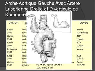 Arche Aortique Gauche Avec Artere
Lusorienne Droite et Diverticule de
Kommerell (13pt)
Author Type of
OR
Procedure Device
Corral
2003
1 stage
(hybrid)
Bilateral car-subc bypass, lig of ARSA
TEVAR
Talent
(Medtronic)
Hutton
2004
1 stage
(no hybrid)
TEVAR across ARSA
(no revascularization)
TX2
(Cook)
Odero
2007
1 stage
(no hybrid)
TEVAR across ARSA
(no revascularization)
TX2
(Cook)
Mosquera
2007
1 stage
(no hybrid)
TEVAR – no coverage of ARSA Valiant
Kopp
2007
1 stage
(hybrid)
TEVAR across ARSA, with coverage of
LSA
TX2
(Cook)
Kedora
2009
1 stage
(hybrid)
R car-subc bypass, transsubclavian plug
into ARSA, ligation of ARSA
(KOD only 2.1 cm)
Zenith
Excluder
 