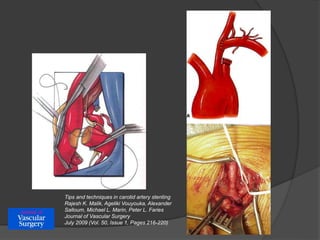 Tips and techniques in carotid artery stenting
Rajesh K. Malik, Ageliki Vouyouka, Alexander
Salloum, Michael L. Marin, Peter L. Faries
Journal of Vascular Surgery
July 2009 (Vol. 50, Issue 1, Pages 216-220)
 