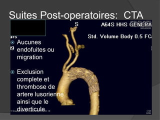 Suites Post-operatoires: CTA
 Aucunes
endofuites ou
migration
 Exclusion
complete et
thrombose de
artere lusorienne
ainsi que le
diverticule
 