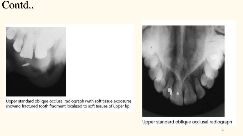 Technique of dental radiographic