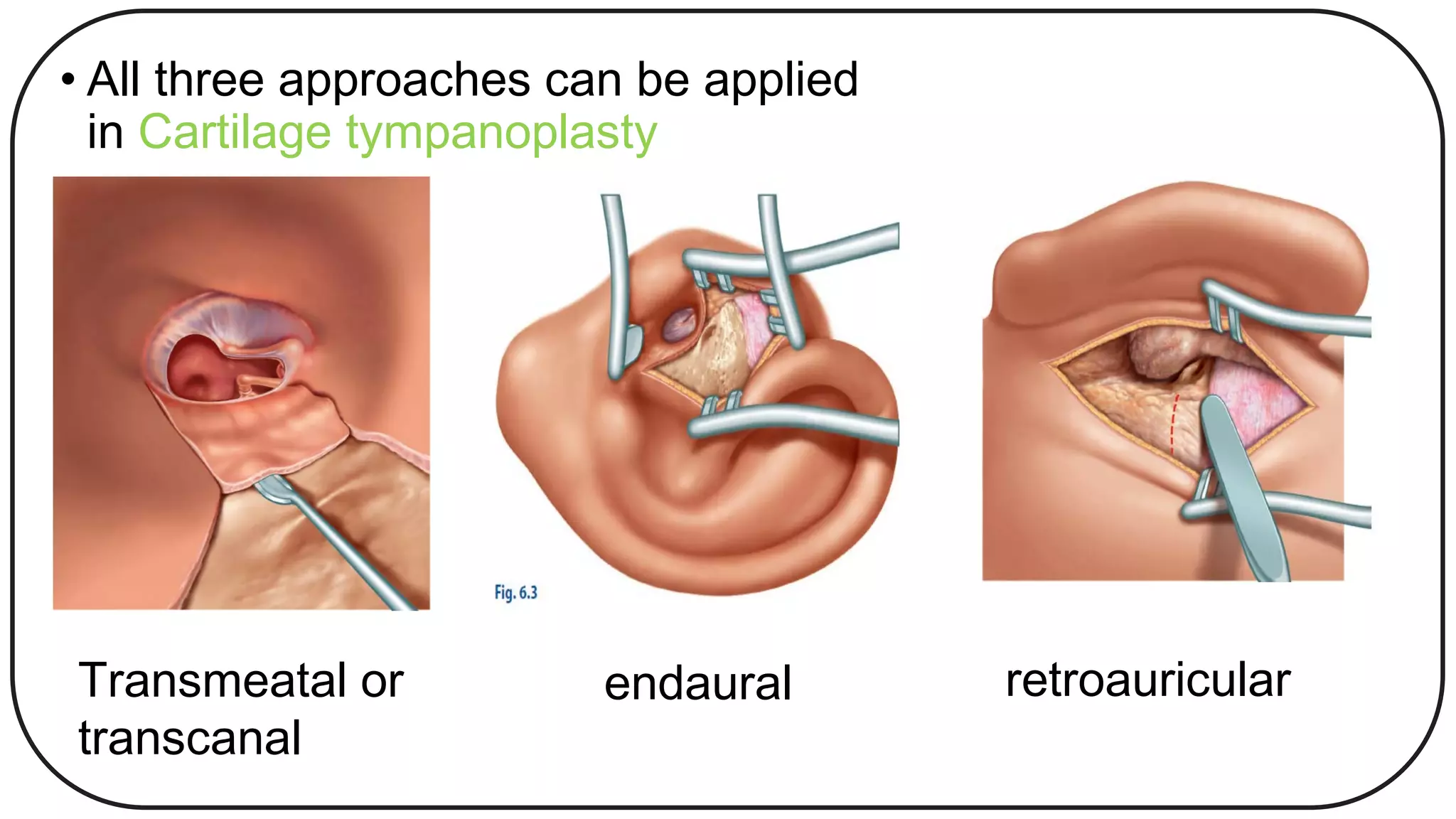 Technique of harvesting cartilage graft for cartilage tympanoplasty Dr ...