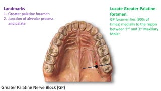 Technique of maxillary anesthesia | PPTX