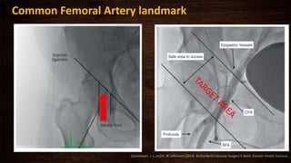 Common Femoral Artery landmark
Cronenwett, J. L. and K. W. Johnston (2014). Rutherford's Vascular Surgery E-Book, Elsevier Health Sciences.
 