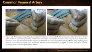 Common Femoral Artery
Jackson, J. E. and J. F. Meaney (2015). "Angiography: Principles, Techniques." Grainger and Allison's Diagnostic Radiology: Interventional Imaging: 2.
 