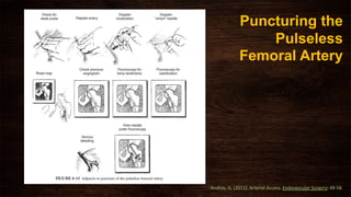Puncturing the
Pulseless
Femoral Artery
Andros, G. (2011). Arterial Access. Endovascular Surgery: 49-58.
 