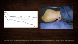 Ye, M., et al. (2013). "Retrograde popliteal approach for challenging occlusions of the femoral-popliteal arteries." Journal of vascular surgery 58(1): 84-89.
 