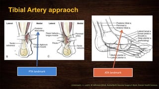 Tibial Artery appraoch
Cronenwett, J. L. and K. W. Johnston (2014). Rutherford's Vascular Surgery E-Book, Elsevier Health Sciences.
ATA landmarkPTA landmark
 