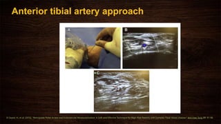 Anterior tibial artery approach
El-Sayed, H., et al. (2016). "Retrograde Pedal Access and Endovascular Revascularization: A Safe and Effective Technique for High-Risk Patients with Complex Tibial Vessel Disease." Ann Vasc Surg 31: 91-98.
 