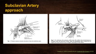 Subclavian Artery
approach
Andros, G. (2011). Arterial Access. Endovascular Surgery: 49-58.
 