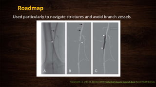 Roadmap
Used particularly to navigate strictures and avoid branch vessels
Cronenwett, J. L. and K. W. Johnston (2014). Rutherford's Vascular Surgery E-Book, Elsevier Health Sciences.
 