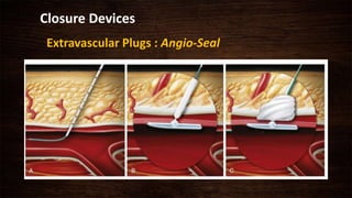 Closure Devices
Extravascular Plugs : Angio-Seal
 