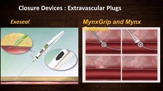 Closure Devices : Extravascular Plugs
Exoseal MynxGrip and Mynx
Cadence
 