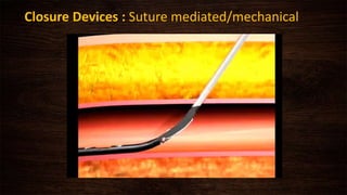 Closure Devices : Suture mediated/mechanical
 