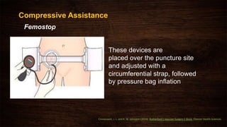 These devices are
placed over the puncture site
and adjusted with a
circumferential strap, followed
by pressure bag inﬂation
Compressive Assistance
Femostop
Cronenwett, J. L. and K. W. Johnston (2014). Rutherford's Vascular Surgery E-Book, Elsevier Health Sciences.
 