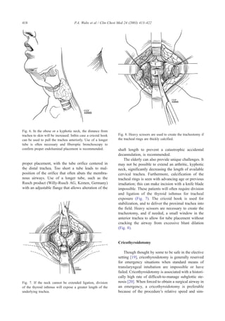 proper placement, with the tube orifice centered in
the distal trachea. Too short a tube leads to mal-
position of the orifice that often abuts the membra-
nous airways. Use of a longer tube, such as the
Rusch product (Willy-Rusch AG, Kemen, Germany)
with an adjustable flange that allows alteration of the
shaft length to prevent a catastrophic accidental
decannulation, is recommended.
The elderly can also provide unique challenges. It
may not be possible to extend an arthritic, kyphotic
neck, significantly decreasing the length of available
cervical trachea. Furthermore, calcification of the
tracheal rings is seen with advancing age or previous
irradiation; this can make incision with a knife blade
impossible. These patients will often require division
and ligation of the thyroid isthmus for tracheal
exposure (Fig. 7). The cricoid hook is used for
stabilization, and to deliver the proximal trachea into
the field. Heavy scissors are necessary to create the
tracheotomy, and if needed, a small window in the
anterior trachea to allow for tube placement without
cracking the airway from excessive blunt dilation
(Fig. 8).
Cricothyroidotomy
Though thought by some to be safe in the elective
setting [19], cricothyroidotomy is generally reserved
for emergency situations when standard means of
translaryngeal intubation are impossible or have
failed. Cricothyroidotomy is associated with a histori-
cally high rate of difficult-to-manage subglottic ste-
nosis [20]. When forced to obtain a surgical airway in
an emergency, a cricothyroidotomy is preferable
because of the procedure’s relative speed and sim-
Fig. 6. In the obese or a kyphotic neck, the distance from
trachea to skin will be increased. Inthis case a cricoid hook
can be used to pull the trachea anteriorly. Use of a longer
tube is often necessary and fiberoptic bronchoscopy to
confirm proper endoluminal placement is recommended.
Fig. 7. If the neck cannot be extended ligation, division
of the thyroid isthmus will expose a greater length of the
underlying trachea.
Fig. 8. Heavy scissors are used to create the tracheotomy if
the tracheal rings are thickly calcified.
P.A. Walts et al / Clin Chest Med 24 (2003) 413–422418
 