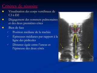 Critères de réussite Visualisation des corps vertébraux de C3 à D2  Dégagement des sommets pulmonaires et des deux premières côtes Bien de face Position médiane de la trachée Épineuses médianes par rapport à la ligne des pédicules Distance égale entre l’uncus et l’épineuse des deux côtés D2 C3 