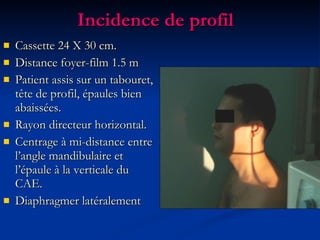 Incidence de profil Cassette 24 X 30 cm. Distance foyer-film 1.5 m  Patient assis sur un tabouret, tête de profil, épaules bien abaissées. Rayon directeur horizontal. Centrage à mi-distance entre l’angle mandibulaire et l’épaule à la verticale du CAE. Diaphragmer latéralement 