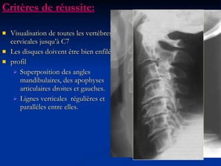 Critères de réussite: Visualisation de toutes les vertèbres cervicales jusqu’à C7 Les disques doivent être bien enfilés profil Superposition des angles mandibulaires, des apophyses articulaires droites et gauches. Lignes verticales  régulières et parallèles entre elles. 