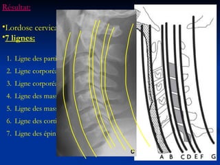 Ligne des parties molles  Ligne corporéale antérieure Ligne corporéale postérieure  Ligne des masses articulaires antérieure Ligne des masses articulaires postérieure Ligne des corticales spino-lamaires Ligne des épineuses Résultat: Lordose cervicale 7 lignes: 