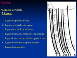 Ligne des parties molles  Ligne corporéale antérieure Ligne corporéale postérieure  Ligne des masses articulaires antérieure Ligne des masses articulaires postérieure Ligne des corticales spino-lamaires Ligne des épineuses Résultat: Lordose cervicale 7 lignes: 