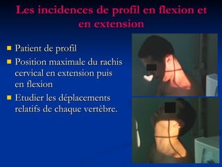 Les incidences de profil en flexion et en extension Patient de profil Position maximale du rachis cervical en extension puis en flexion Etudier les déplacements relatifs de chaque vertèbre. 