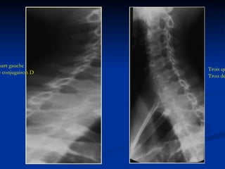 Trois quart droit Trou de conjugaison G Trois quart gauche Trou de conjugaison D 