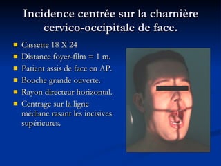 Incidence centrée sur la charnière cervico-occipitale de face. Cassette 18 X 24  Distance foyer-film = 1 m. Patient assis de face en AP. Bouche grande ouverte. Rayon directeur horizontal. Centrage sur la ligne médiane rasant les incisives supérieures. 