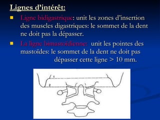 Lignes d’intérêt: Ligne bidigastrique : unit les zones d’insertion des muscles digastriques: le sommet de la dent ne doit pas la dépasser. La ligne bimastoïdienne:  unit les pointes des mastoïdes: le sommet de la dent ne doit pas    dépasser cette ligne > 10 mm. 