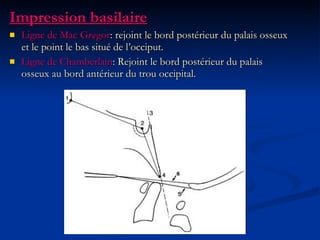 Impression basilaire Ligne de Mac Gregor : rejoint le bord postérieur du palais osseux et le point le bas situé de l’occiput. Ligne de Chamberlain : Rejoint le bord postérieur du palais osseux au bord antérieur du trou occipital. 