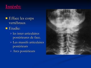 Intérêt: Efface les corps vertébraux Etudie:  les inter-articulaires postérieures de face. Les massifs articulaires postérieurs Arcs postérieurs 