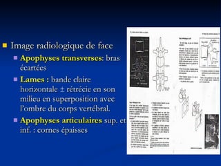 Image radiologique de face Apophyses transverses : bras écartées Lames :  bande claire horizontale  ±  rétrécie en son milieu en superposition avec l’ombre du corps vertébral. Apophyses articulaires  sup. et inf. : cornes épaisses 