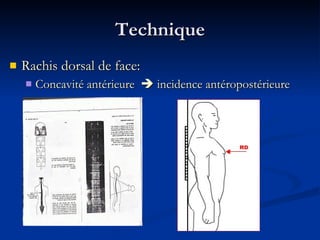 Technique Rachis dorsal de face: Concavité antérieure    incidence antéropostérieure 