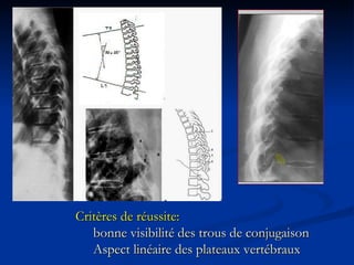 Critères de réussite:  bonne visibilité des trous de conjugaison Aspect linéaire des plateaux vertébraux 