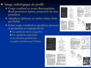 Image radiologique de profil: Corps vertébral en avant: Rectangulaire, Bord postérieur épaissi: projection du mur postérieur Apophyse épineuse en arrière mince donc peu lisible Entre corps vertébral et apophyse épineuse se projettent en superposition: Les pédicules droits et gauches Les apophyses articulaires  et les colonnes postérieures  en partie constitués par l’isthme 